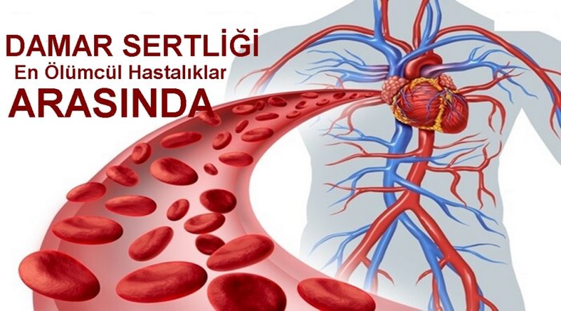 Damar Sertliği En Ölümcül Hastalıklar Arasında!