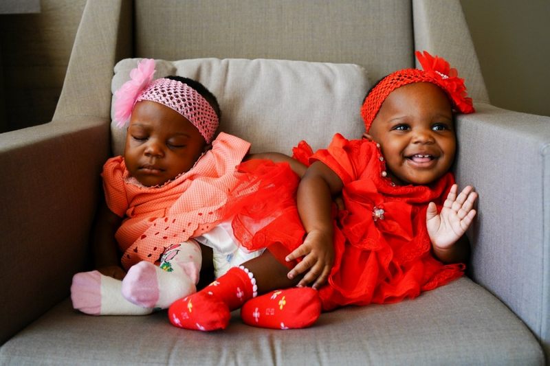 Kamerunlu Yapışık İkizler,27 saatlik ameliyatla kendi bedenlerine kavuştular!