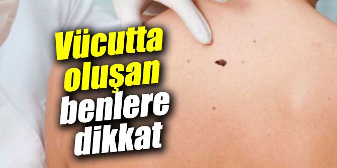 Çapı 5mm’den Büyük Benlere  Dikkat!