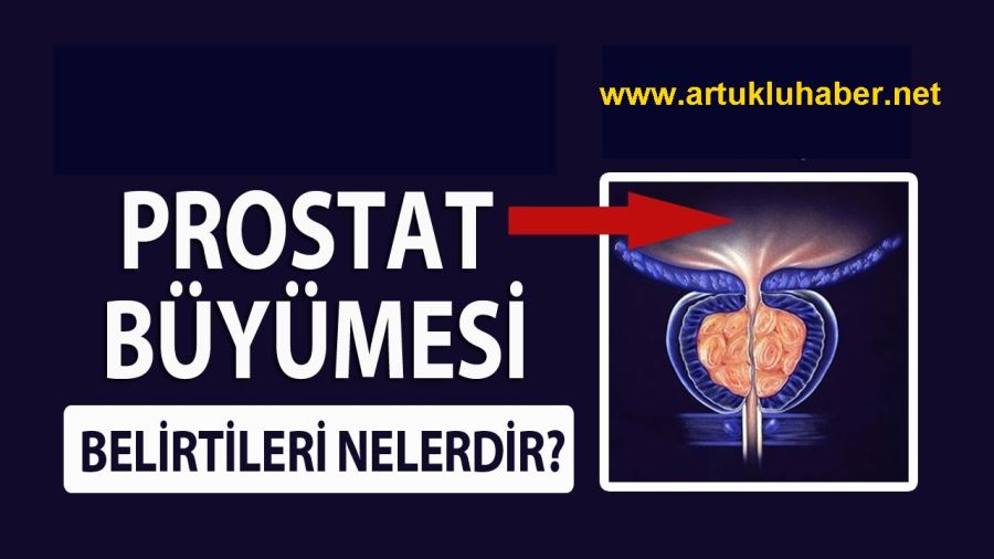 PROSTAT BÜYÜMESİNİN BELİRTİLERİ