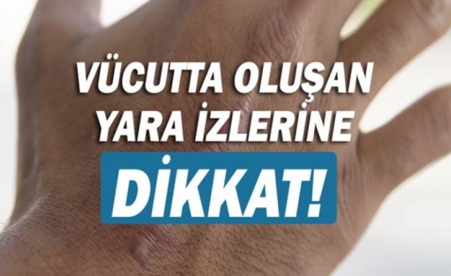 Vücutta Oluşan Yara İzlerine Dikkat! 