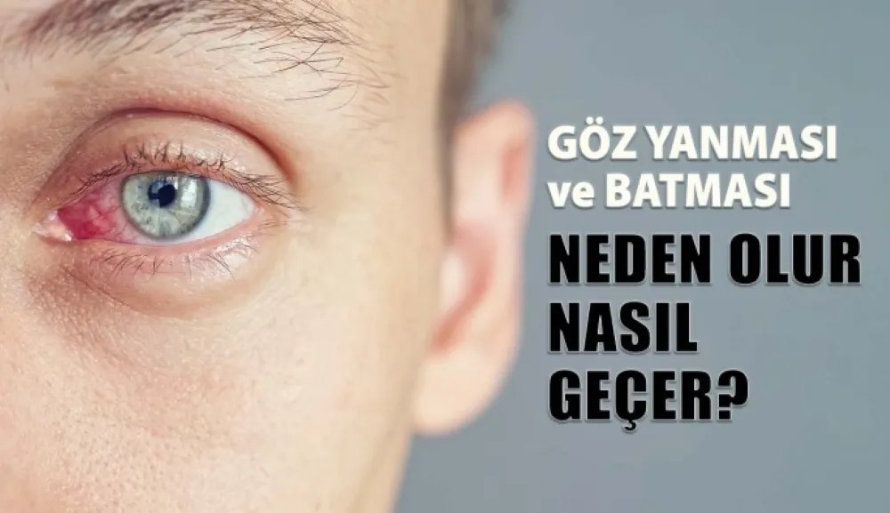 Göz Yanması Neden Olur?