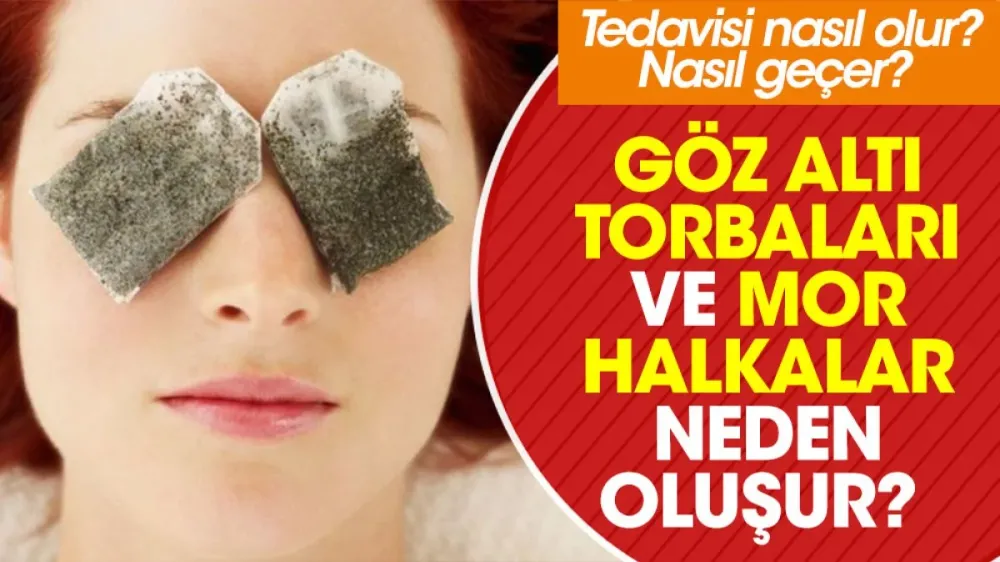 Göz Altı Torbaları Neden Olur? Nelere Dikkat Edilmeli?